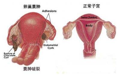 女性卵巢囊肿的原因有什么